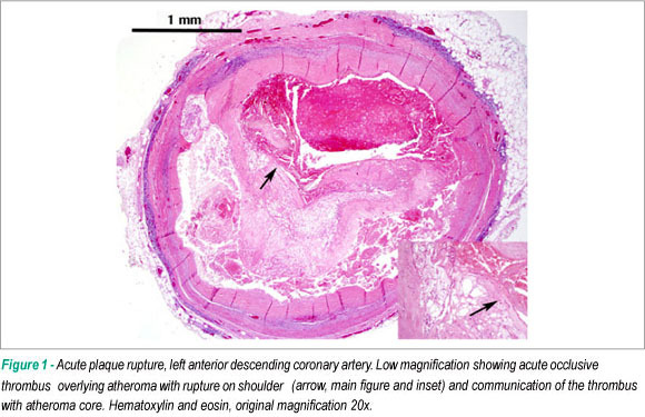 Frequency of acute plaque ruptures and thin cap atheromas at sites of maximal stenosis