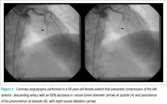 Myocardial bridging: therapeutic and clinical development