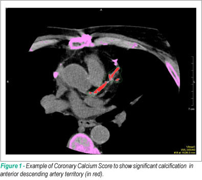 Coronary calcium score as predictor of stenosis and events in pretransplant renal chronic failure