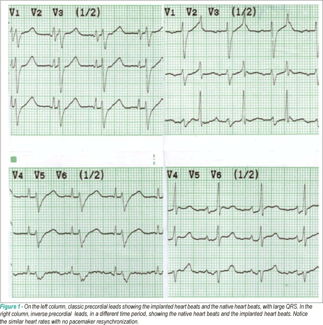 Experience with heterotopic heart transplantation in patients with elevated pulmonary vascular resistance: late follow-up