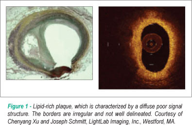 Use of optical coherence tomography for accurate characterization of atherosclerosis