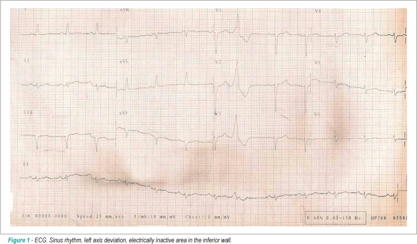 Case 1 - 59-year-old male patient with severe obesity, arterial hypertension and heart failure submitted to anticoagulation therapy for atrial fibrillation, presented cerebrovascular accident and septicemia