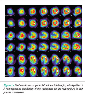 Prevalence of induced ischemia by mental distress