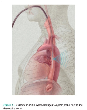Ischemic preconditioning influence ventricular function in off-pump revascularization surgery