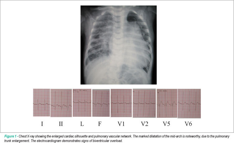 Case 2/2010 Five-month-old Male Infant with Subpulmonary Interventricular Communication and Aortic Coarctation