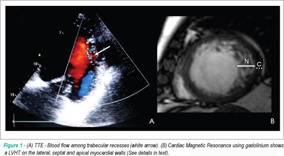 Ischemic stroke as the first manifestation of severe ventricular hypertrabeculation/non-compaction
