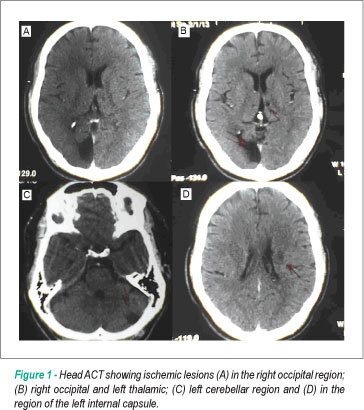 Resistance to activated protein C and ischemic arterial disease in a young man