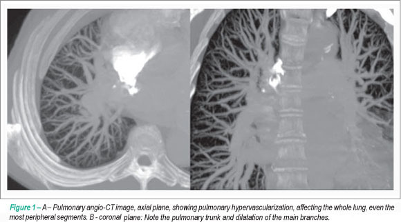 Hereditary hemorrhagic telangiectasia: rare cause of pulmonary hypertension?