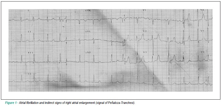 Case 2 - seventy-year-old man with mitral stenosis and pulmonary fibrosis, who developed sepsis after balloon mitral valvoplasty
