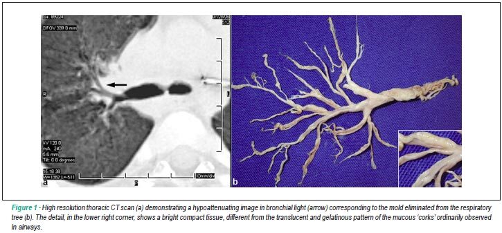 Association of plastic bronchitis to protein-losing enteropathy after fontan operation