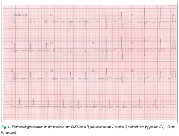 Distrofia muscular de Duchenne: análise eletrocardiográfica de 131 pacientes