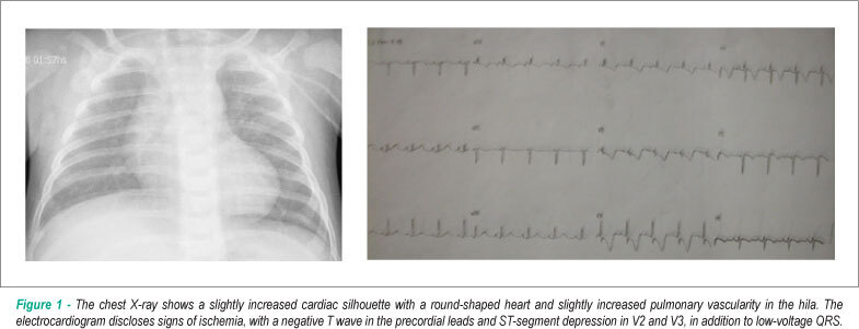 Case 3/2010 - Two-month-old male infant with fistula from the anterior interventricular coronary artery to the pulmonary trunk