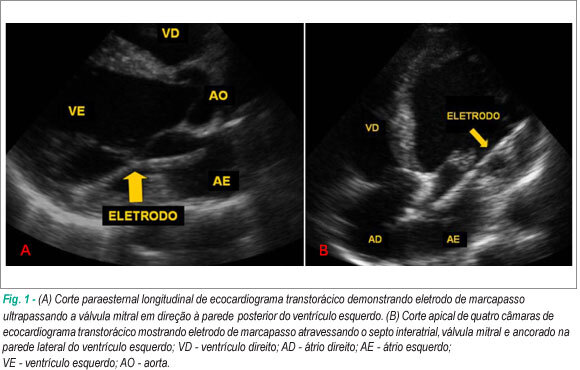Posicionamento ectópico de eletrodo de marcapasso