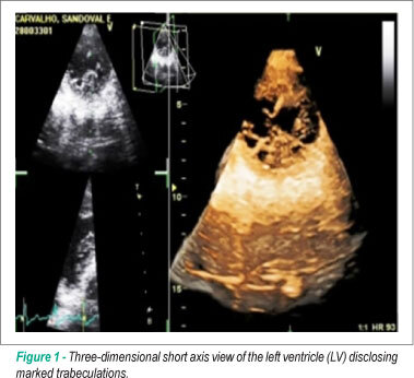 Noncompaction of the myocardium in a patient with acute myocardial infarction