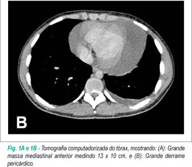Utilidade da pericardioscopia no diagnóstico de derrame pericárdico