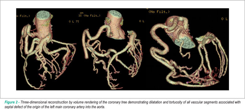 Anomalous origin of Coronary Artery (ALCAPA) in 64-channel TC scanner