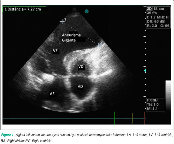 Giant left ventricular aneursym