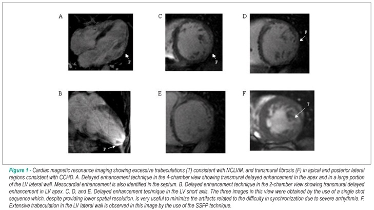Noncompaction of the myocardium, Chagas' disease and dysfunction: a case report