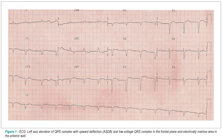 Case 4: 77-Year-old female patient with heart failure, normal left ventricular systolic function and signs of restrictive cardiopathy