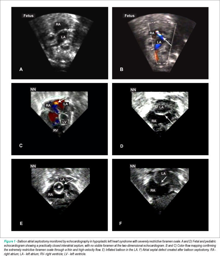Balloon atrial septostomy guided by echocardiography in a neonatal intensive care unit