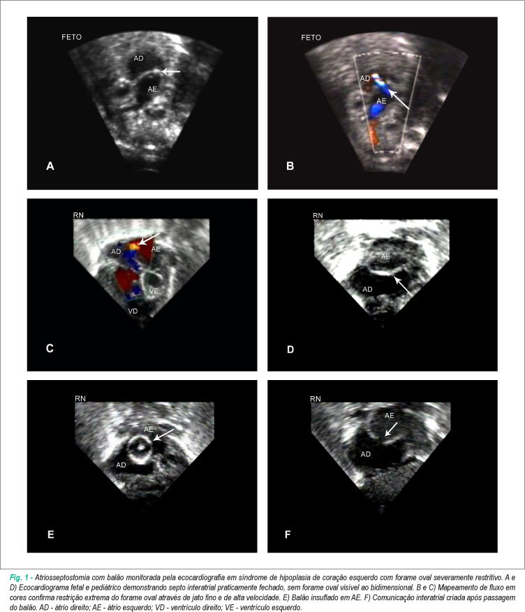 Atriosseptostomia por cateter balão guiada pela ecocardiografia em unidade de terapia intensiva neonatal