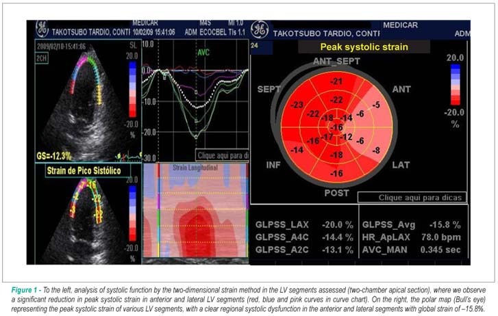 Two-dimensional strain in Takotsubo cardiomyopathy