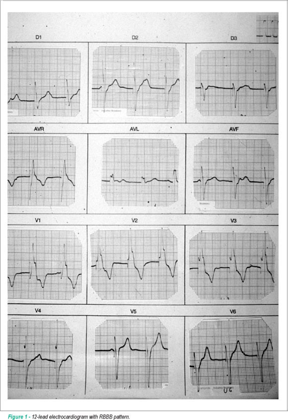 Pacemaker electrode misplaced in the left ventricle