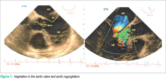 Infectious endocarditis due to Streptococcus bovis in a patient with colon carcinoma