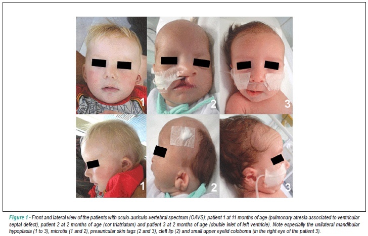 Oculo-auriculo-vertebral spectrum in patients with congenital heart defects