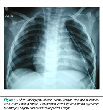 Case 6/2010 - 14 months female infant with double aortic isthmus coarctation