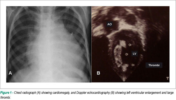 Takayasu's disease with severe heart and arterial involvement in a preschool-age child