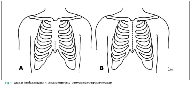 Miniesternotomia na cirurgia de revascularização miocárdica preserva função pulmonar pós-operatória