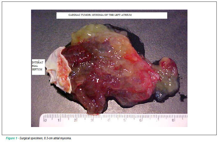 Giant atrial myxoma mimicking severe mitral stenosis in young patient