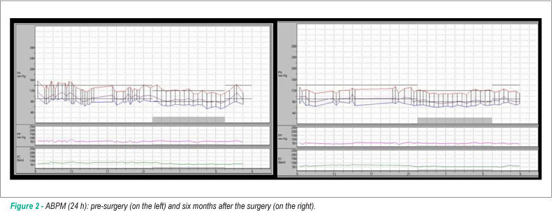 Secondary hypertension to rare adrenal gland tumor