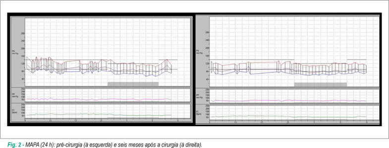 Hipertensão arterial secundária a tumor raro da glândula adrenal