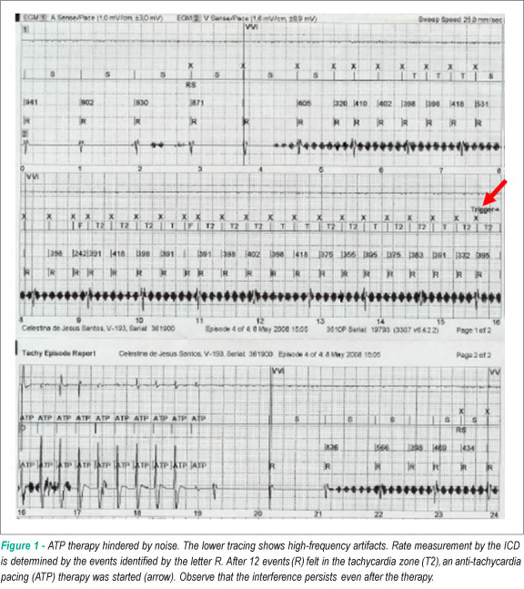 Delayed right ventricular perforation in patient with implantable cardioverter - defibrillator