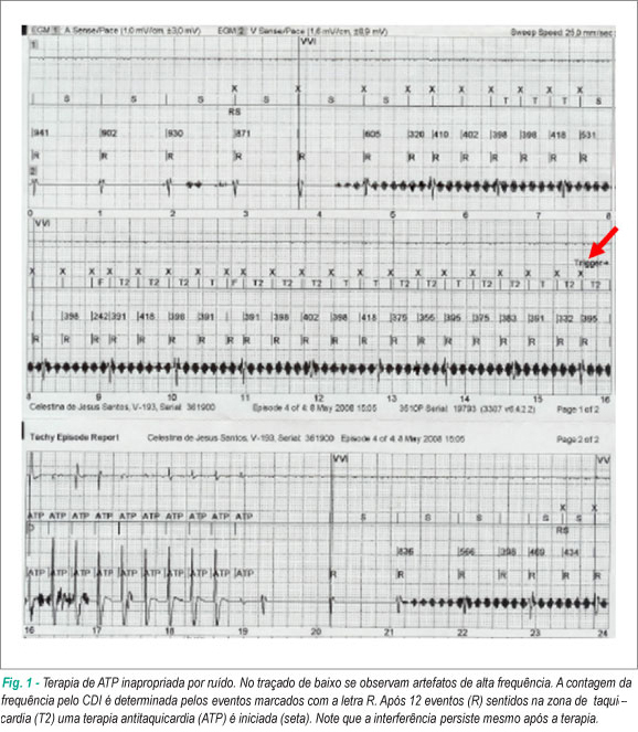 Perfuração tardia de ventrículo direito em portador de cardioversor desfibrilador implantável