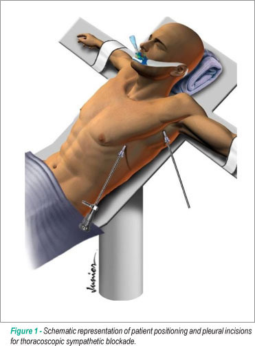Endoscopic left sympathetic blockade in the treatment for dilated cardiomyopathy