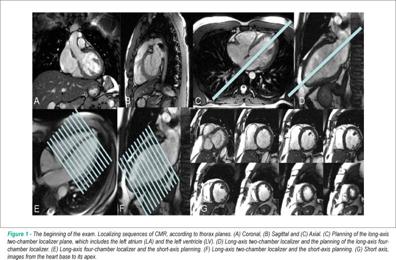 Cardiac magnetic resonance and its anatomical planes: How do i do it?