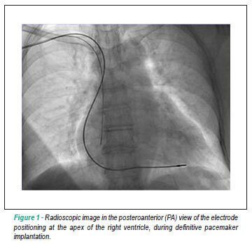 Alternative endocardial sites for artificial cardiac stimulation