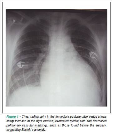 Case 1/2011: 15-year-old male adolescent with congenital tricuspid insufficiency simulating Ebstein's anomaly