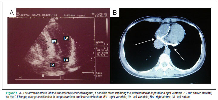 Constrictive pericarditis with extensive calcification