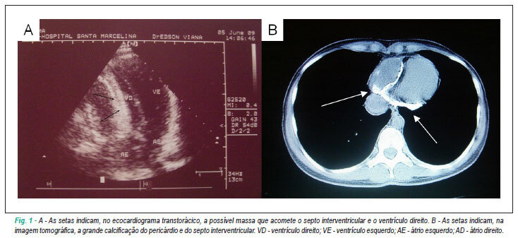 Pericardite constritiva com calcificação extensa