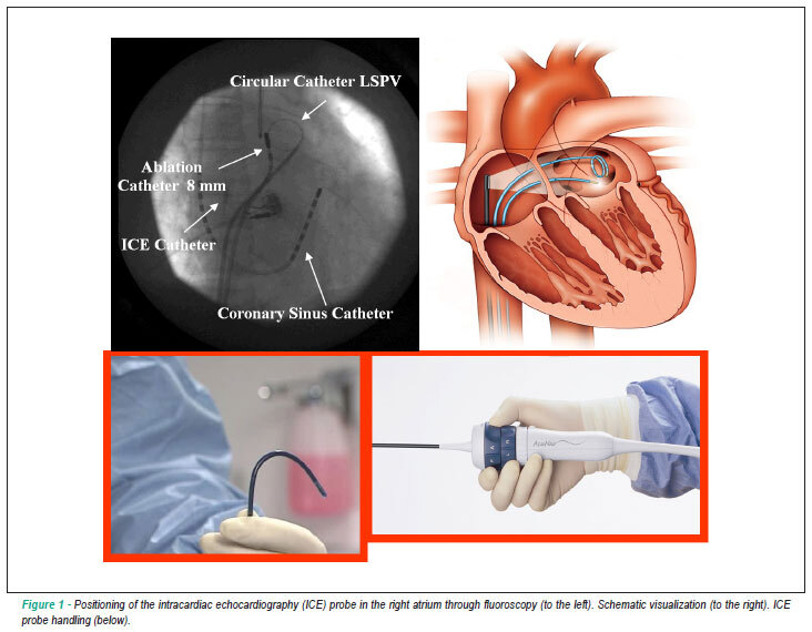 Use of intracardiac echocardiography in the electrophysiology laboratory