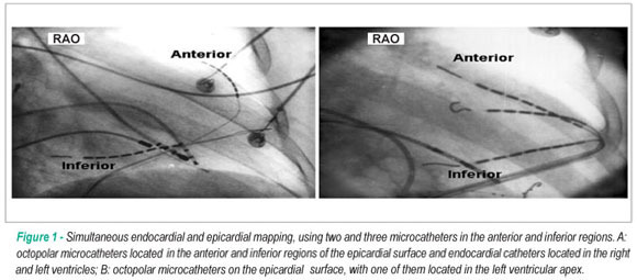 Epicardial mapping of sustained ventricular tachycardia in nonischemic heart disease