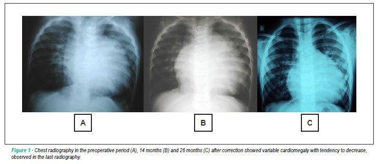 Case 2/2011: forty-three months old child, male, with multiple ventricular septal defect, unfavorable clinical course, long term after anatomical correction