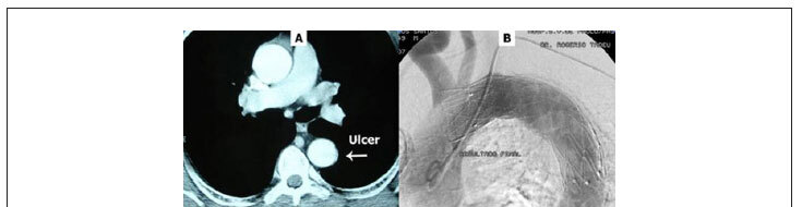 Endovascular stent-graft treatment of penetrating aortic ulcer