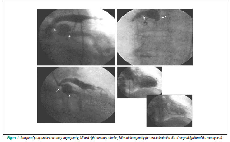 Coronary artery bypass graft (CABG) in the presence of coronary aneurysms