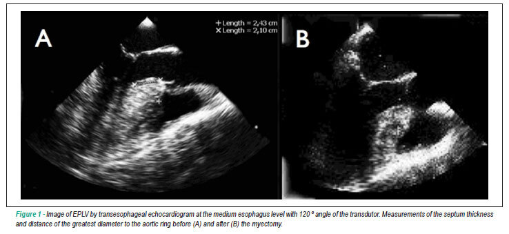 Intraoperative evaluation and surgical planning in the hypertrophic cardiomyopathy
