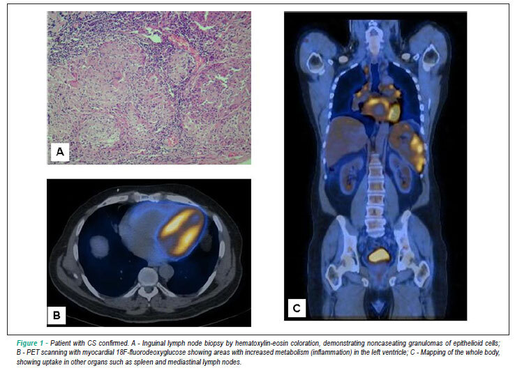 Cardiac electrophysiological assessment in patients with sarcoidosis